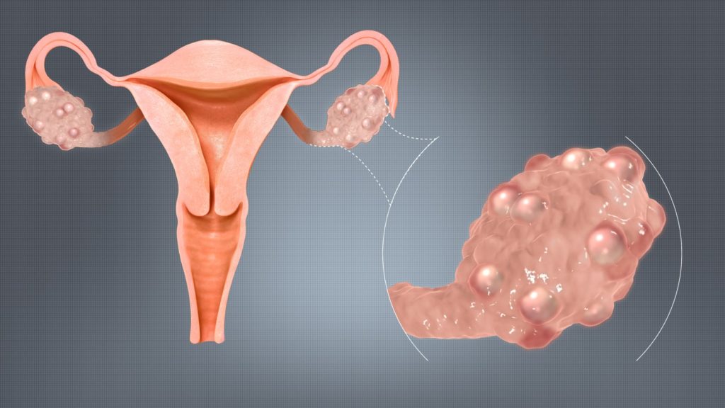 8 de mayo, día mundial del cáncer de ovarios: más de 250.000 víctimas en el mundo