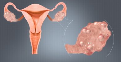 8 de mayo, día mundial del cáncer de ovarios: más de 250.000 víctimas en el mundo