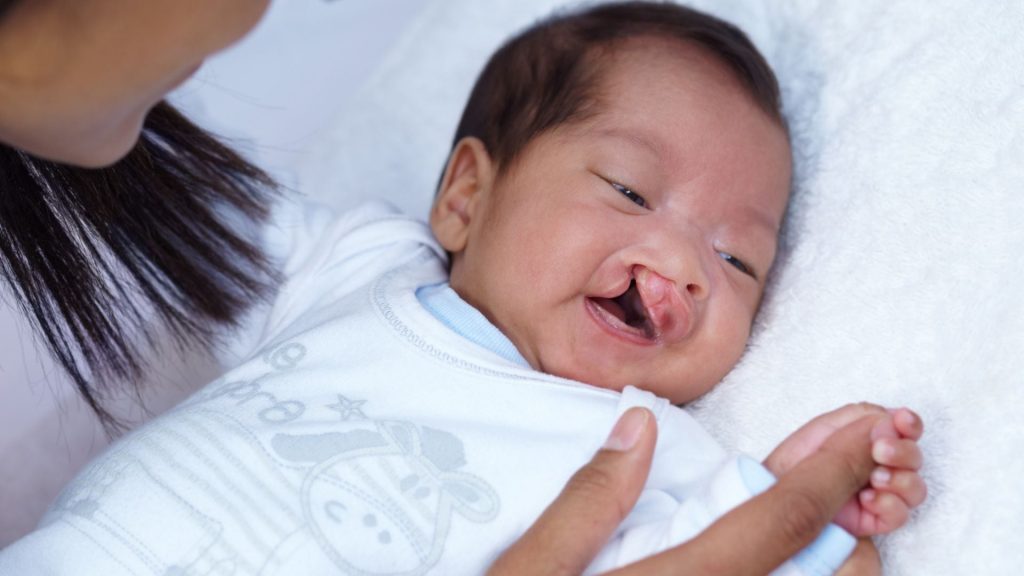 Más de 50 niños recibirán cirugías de labio leporino y paladar hendido por la Fundación Cruz Jiminián