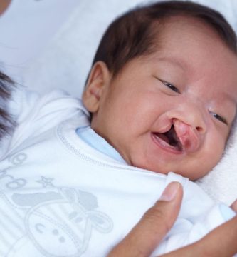 Más de 50 niños recibirán cirugías de labio leporino y paladar hendido por la Fundación Cruz Jiminián