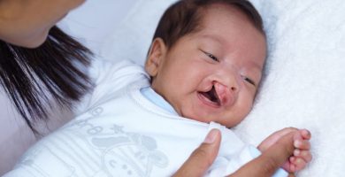 Más de 50 niños recibirán cirugías de labio leporino y paladar hendido por la Fundación Cruz Jiminián