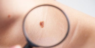 Melanoma maligno, cáncer de piel silencioso muy agresivo que si se detecta a tiempo el pronóstico cambia