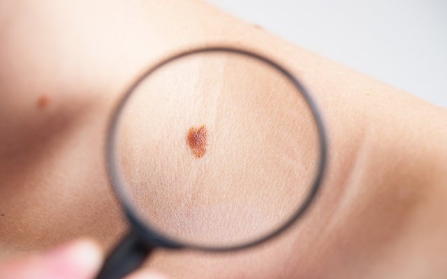 Melanoma maligno, cáncer de piel silencioso muy agresivo que si se detecta a tiempo el pronóstico cambia