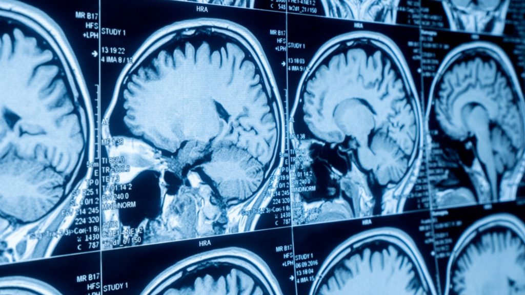 Día Internacional de los Tumores Cerebrales, con la finalidad de sensibilizar a la población acerca de las causas