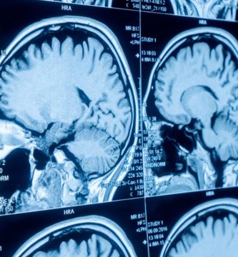 Día Internacional de los Tumores Cerebrales, con la finalidad de sensibilizar a la población acerca de las causas