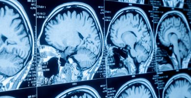 Día Internacional de los Tumores Cerebrales, con la finalidad de sensibilizar a la población acerca de las causas