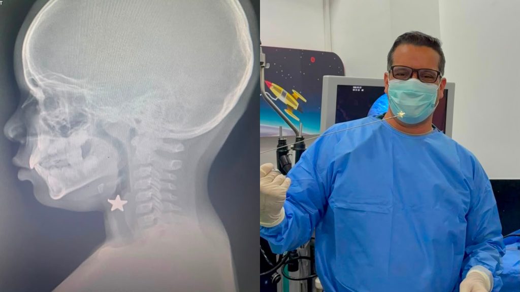 ¡Milagro médico! Hospital Hugo Mendoza salva a niño que aspiró una pieza metálica en forma de estrella