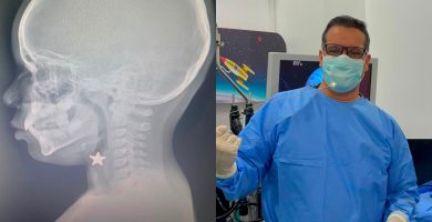 ¡Milagro médico! Hospital Hugo Mendoza salva a niño que aspiró una pieza metálica en forma de estrella