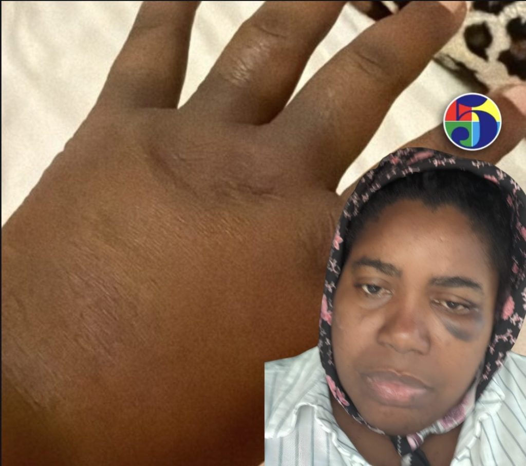 Maestra denuncia que ella, su esposo y su hijo fueron agredidos a batazos por una pareja en Higüey
