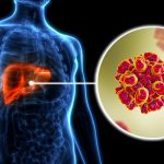 OMS advierte sobre casos de hepatitis con 1.3 millones de fallecimientos