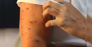 Salud Pública confirma dos casos de mpox en RD