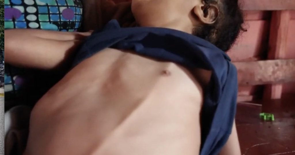 Salud Pública atenderá caso de niño que necesita válvula