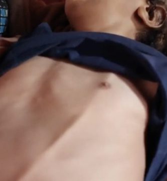 Salud Pública atenderá caso de niño que necesita válvula