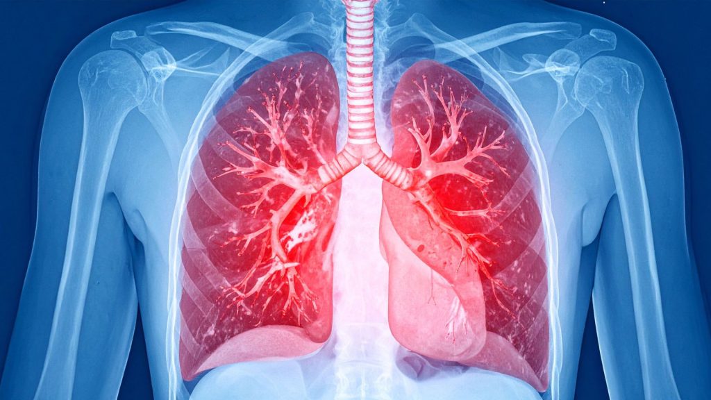 Este sábado se conmemora el Día Mundial del Cáncer de Pulmón